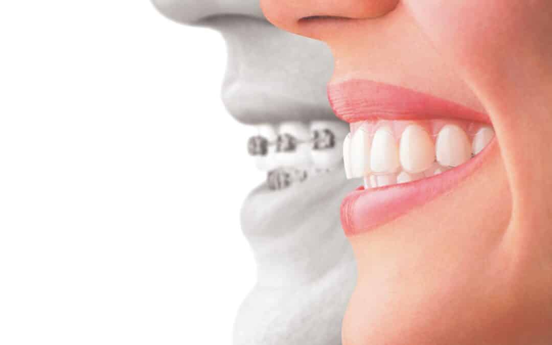 Ask Your Port Lavaca Dentist: What’s the difference between Invisalign and Metal Braces?
