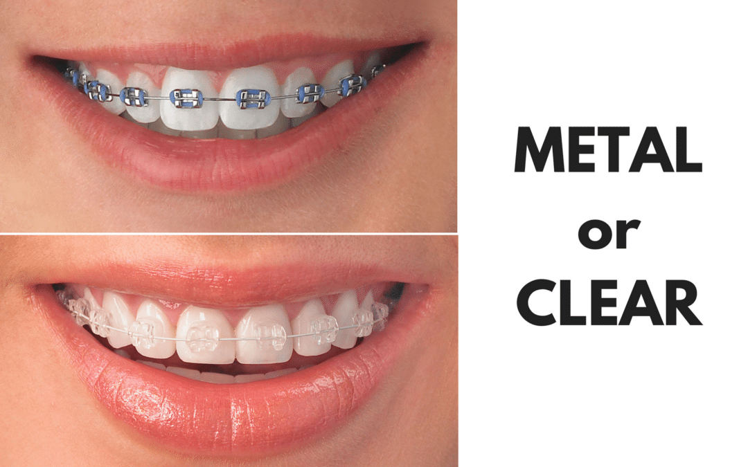 Ask Your Port Lavaca Dentist: Should I Get Metal or Clear Braces?