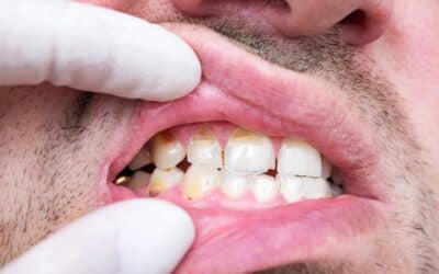 Understanding Chipped Teeth: When Should You Seek Emergency Dental Care?