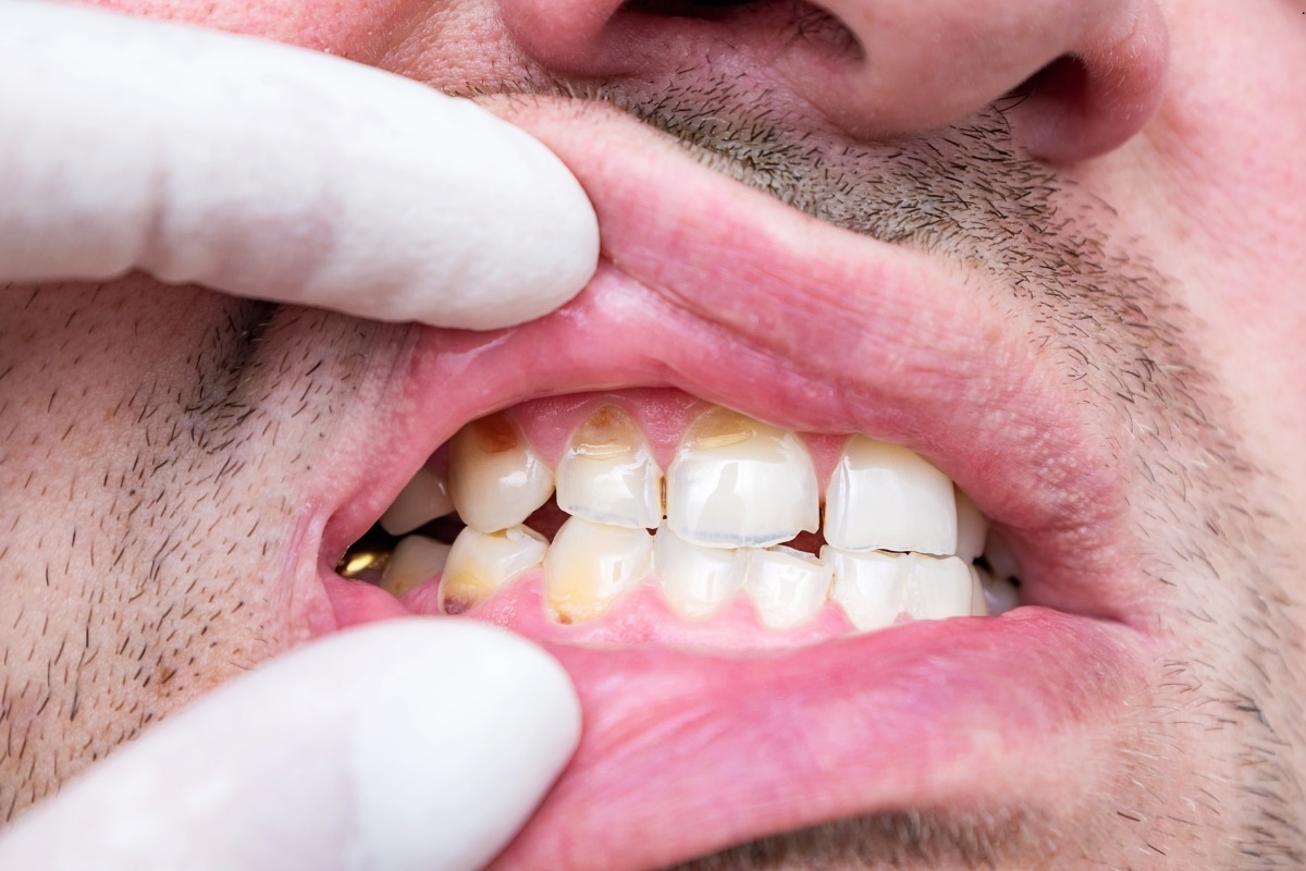 Chipped Tooth Treatment at Port Lavaca Dentistry